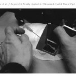 Augmented Reality Applied to Ultrasound-Guided Breast Cyst Aspiration