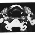 Examination of the Extracranial Carotid Bifurcation by Thin-Section Dynamic CT